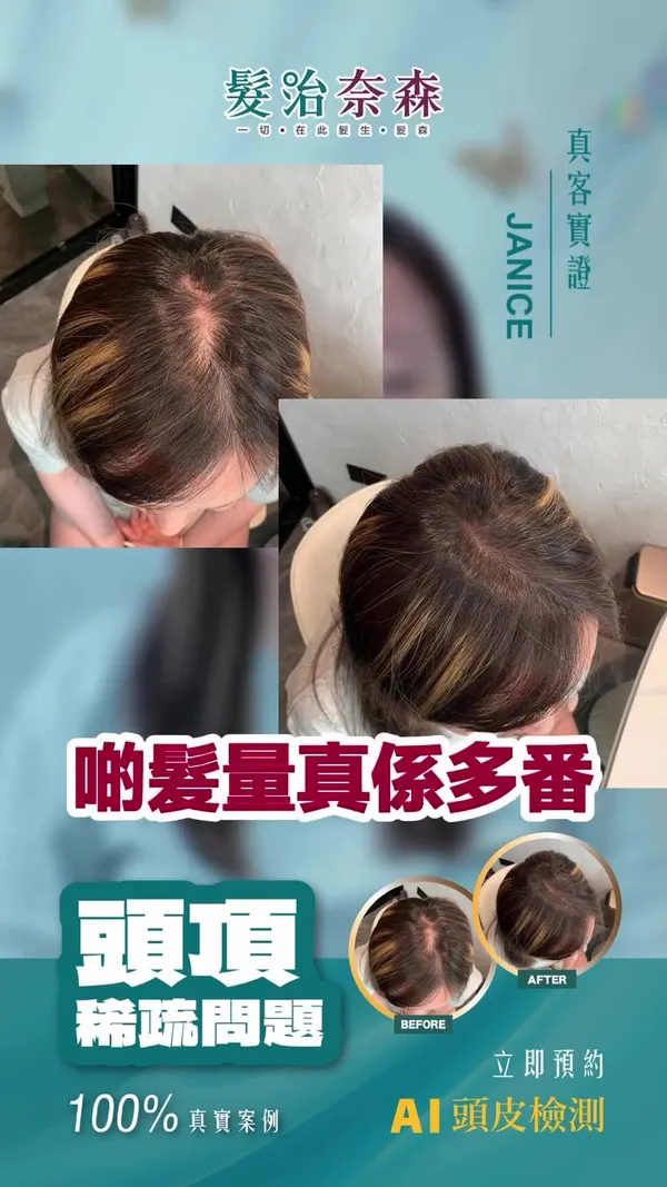 ##髮治奈森 ##髮際線後移 ##頭皮發炎 髮型美甲作品