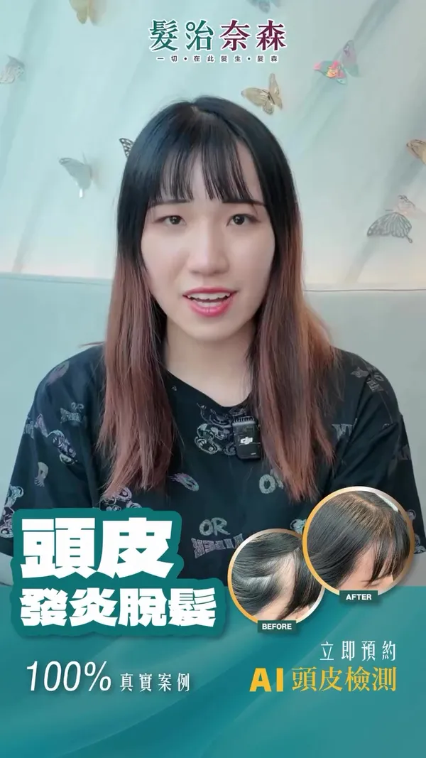 ##髮治奈森 ##頭皮敏感 ##急性脫髮 髮型美甲作品